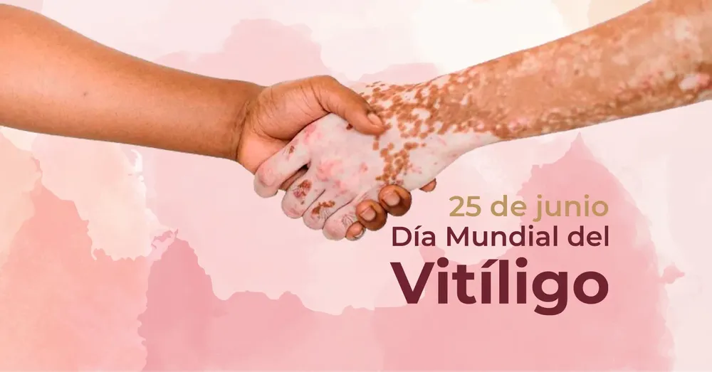 BLOG_PRINCIPAL_25_JUNIO_VITILIGO