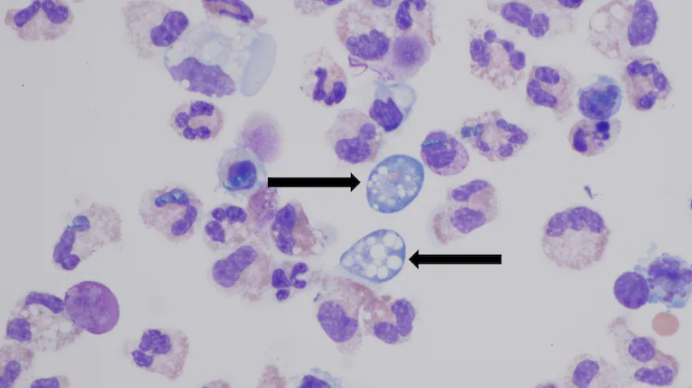 la-bacteria-naegleria-fowleri-infecta-a-las-personas-al-viajar-por-la-nariz-hasta-el-cerebro-donde-consume-tejido-cerebral-foto-gentileza-cdc-GZZVZYJED5EBBIWAB4ZDBSF3UI