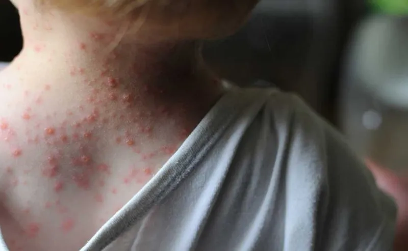 VirueladelMono-1-800-L